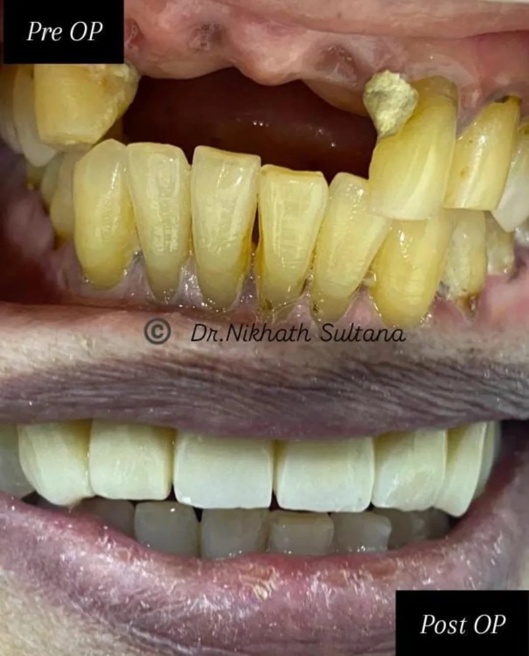 Veneers Case 3